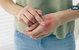皮膚有傷口怎麼辦？如何讓傷口快速癒合？醫教「急性VS慢性」傷口照護