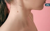 為什麼身體會長肉芽？可以自己剪掉嗎？揭秘「皮膚贅疣」7QA一次看