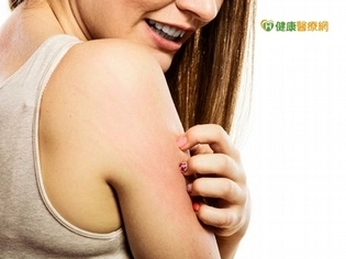 潮濕悶熱+愛喝冰涼品 濕疹易反復發作