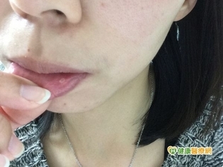 嘴破在同一區域逾2週未好　恐是癌變前兆