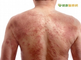長期罹患乾癬恐併發關節炎 及早治療為關鍵