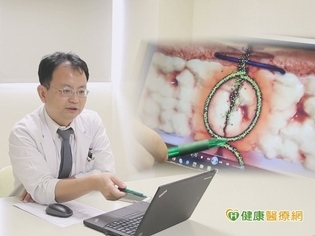 WHO:三氯沙塗層抗菌縫線可降低感染風險