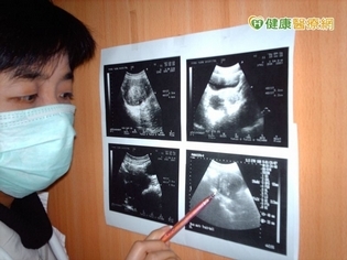 巧克力囊腫別拖延 中醫調整體質可改善