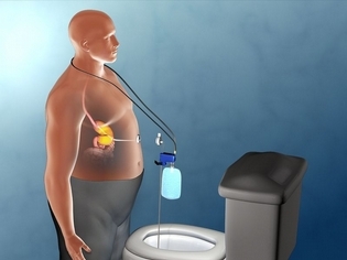 減重新療法!抽出胃內食物有助減肥?