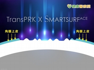 近視雷射新科技如何選擇適合近視手術方式?