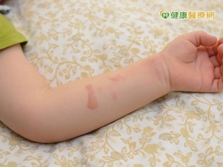 家中寶貝燒燙傷怎麼辦?緊急處置SOP這樣做