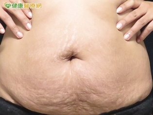 產後腹部鬆弛「皺」煩ㄟ!緊實小腹拉皮竟靠這招