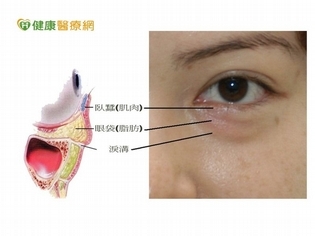 眼袋年齡層降低 過度使用3C產品成誘因