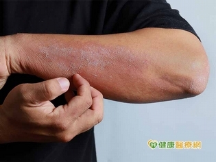 異位性皮膚炎多年 他痛苦抓破皮膚只求好眠