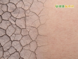 硬皮症竟與肝肺都有關聯 中醫治療從養肝著手