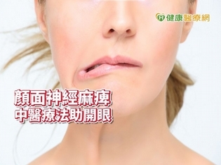 顏面神經麻痺右眼睜不開 針灸助婦人開眼
