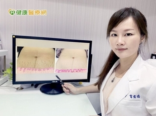 愛的印記讓妳沒自信? 醫美讓妊娠紋從人生中退場
