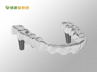 全口咬合重建 植牙搭配隱形牙套新趨勢