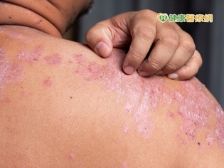 罹患乾癬紅皮症 積極治療遠離危「癬」