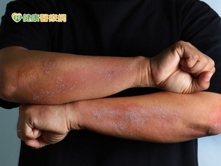 大學生飽受皮膚炎所苦 癢到一度休學無法念書