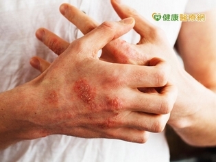 惱人乾癬驚現香腸指 對症治療提升生活品質