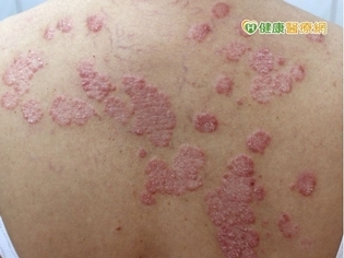 頭皮屑洗不完?臉紅如酒醉 醫師治療、保養乾癬有一套