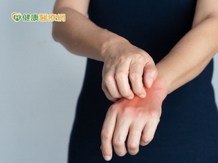 異膚患者告別火燒皮 生物製劑療效亮眼