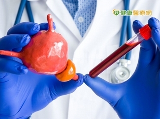 尿液紅通通!老翁竟確診晚期膀胱癌