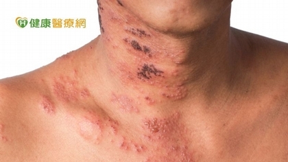 年關將近,忙到焦頭爛額 小心免疫力低下,皮蛇趁虛而入!