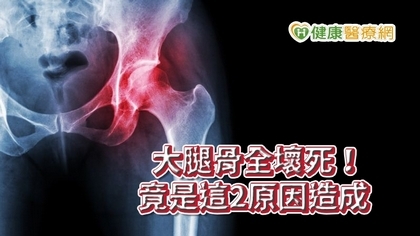 大腿骨全壞死!竟是這2原因造成 疼痛不容忽視