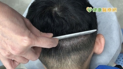 植髮一定要剃頭髮? 運用隱痕密技破除植髮迷思!
