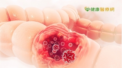 每年定期篩檢大腸癌 醫:有效降低三分之一發生率