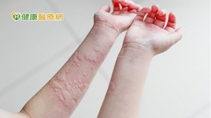 慢性蕁麻疹治不好 反覆發作可考慮生物製劑