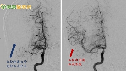 少年腦中風路倒 顱內動脈取栓術撿回一命