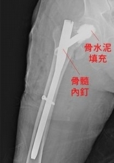 九旬翁髖部骨折 髓內釘搭配骨水泥治療6天出院可行走