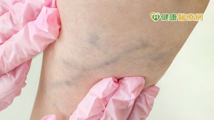 腳腫如蚯蚓又痠麻 輕鬆擺脫靜脈曲張就靠「它」