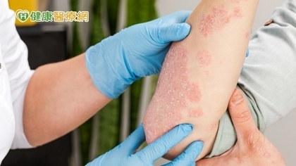 乾癬症狀越顧越遭?治療3大關鍵報你知