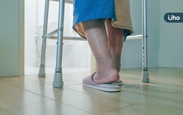 象腿輕忽當水腫?醫師警告:若僅「單腳腫」恐藏奪命危機
