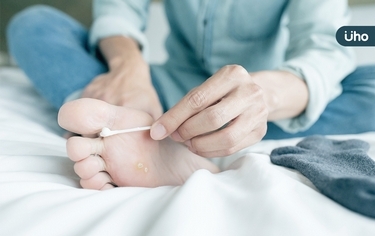 梅雨季讓「香港腳」復發,怎麼辦?預防、治療法、感染風險一次看