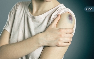 莫名瘀青出血⋯「這種白血病」超難治!醫示警:成人血癌「4大徵兆」