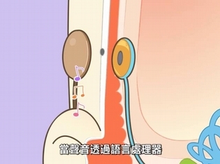 什麼是「人工電子耳」?【聽力小宇宙】第17集