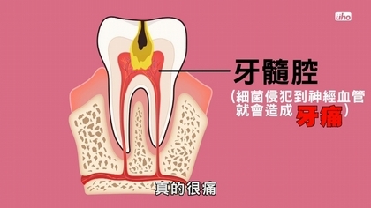 牙齒吃冷吃熱會痛預示著什麼？【看好你的牙】