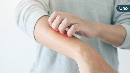 預防冬日乾癬大爆發,精準用藥可有效控制病灶