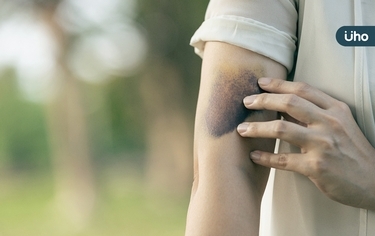 長輩手腳瘀青消不掉，老人性紫斑怎麼處理？預防及保養重點一次看