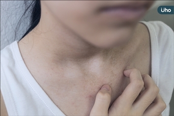 異位性皮膚炎不能拖,精準阻斷發炎細胞是治療關鍵