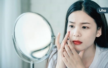 青春痘不只青春期有,除了臉上「這部位」最會長!醫教3招清潔保養