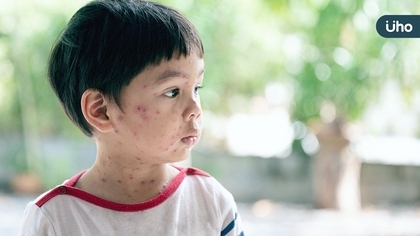 認識帶狀疱疹週 即刻預防帶狀疱疹 精彩人生不打折