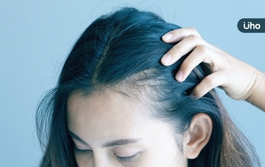 頭皮莫名禿一塊?壓力大小心「鬼剃頭」眉毛、腋下、會陰部都遭殃