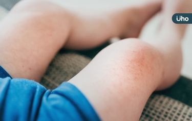 5歲童小腿「滿江紅」以為是蚊子咬⋯擴散全身才知異位性皮膚炎