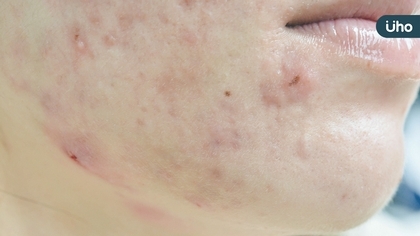 痘痘怎樣都好不了?痘疤女王:A酸使用觀念錯誤「這樣擦」才有效