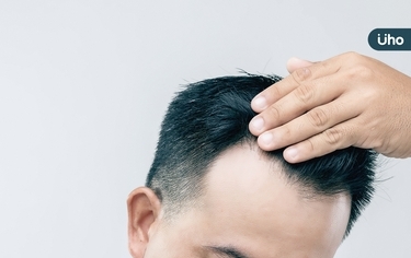 頭皮出油、頭髮變細是禿頭前兆?網議「5大禿頭前兆」一次看