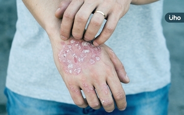 她全身長膿疱破皮潰瘍風一吹就痛!醫揭「這種皮膚病」6症狀恐致命