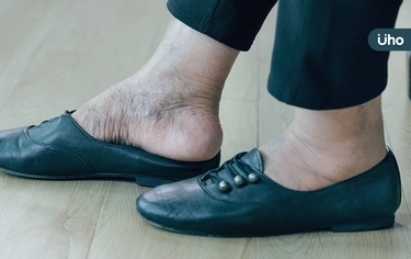 鞋子越買越大、戒指戴不下、下巴變長⋯恐「肢端肥大症」醫揭7大特徵
