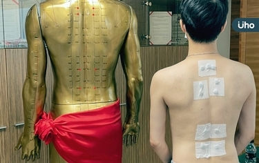 三伏貼怎麼算?看診費用多少?怎麼貼治療最有效?中醫師親揭原理秒懂