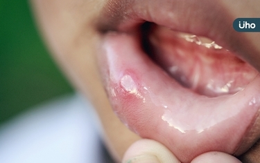 發燒、口臭、牙齦紅腫⋯2歲童不吃飯，竟是「疱疹性齦口炎」作怪